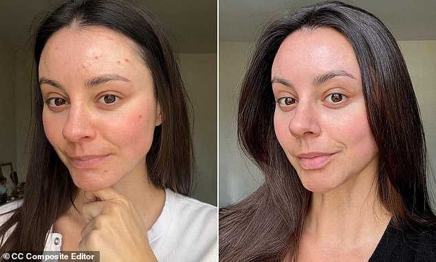Emma North's skin is now a lot better than it was, but she says she still has the urge to scratch until it bleeds
