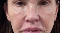 Janice Dickinson shocked the world when she shared the dramatic results of her facelift last week. She's seen before the procedure