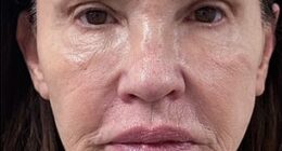 Janice Dickinson shocked the world when she shared the dramatic results of her facelift last week. She's seen before the procedure