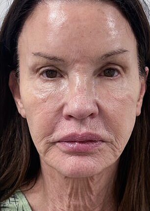 Janice Dickinson shocked the world when she shared the dramatic results of her facelift last week. She's seen before the procedure