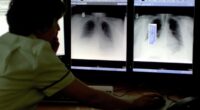 New dual-action drug a ‘promising step forward’ for patients with hard-to-treat lung cancer