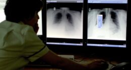 New dual-action drug a ‘promising step forward’ for patients with hard-to-treat lung cancer