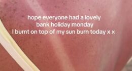 The long weekend was a scorcher across the UK, and the heatwave has continued today with temperatures expected to hit 36C. But some Britons were ill-prepared for the hot weather and clearly forgot to lather on the sunscreen before enjoying their bank holiday