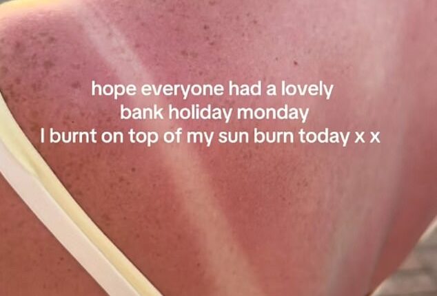 The long weekend was a scorcher across the UK, and the heatwave has continued today with temperatures expected to hit 36C. But some Britons were ill-prepared for the hot weather and clearly forgot to lather on the sunscreen before enjoying their bank holiday