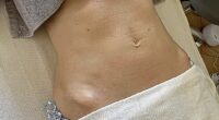 Rosie Green's tummy before the procedure