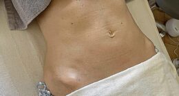 Rosie Green's tummy before the procedure