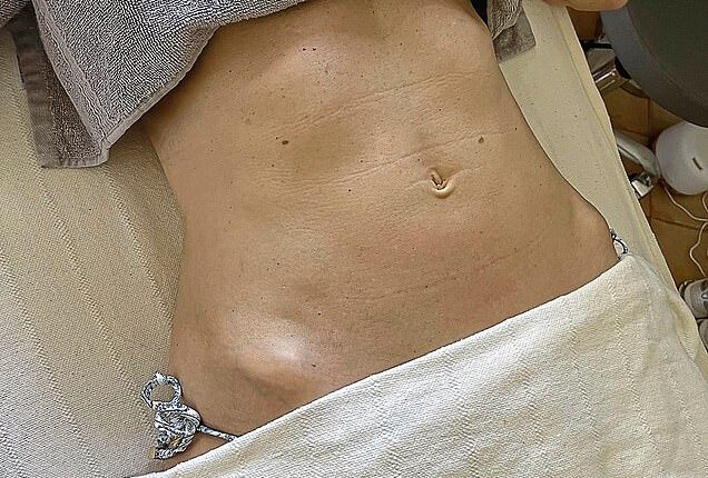 Rosie Green's tummy before the procedure