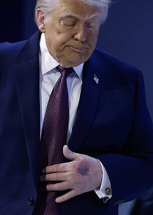 President Donald Trump has been subject to bruising, which doctors blame on his aspirin regimen and shaking hands too vigorously