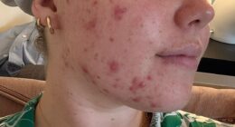 Chloe first got acne when she was 13. By 16, she'd tried every cream and gel and, at 17, her GP put her on the contraceptive pill in the hope it would cure her acne
