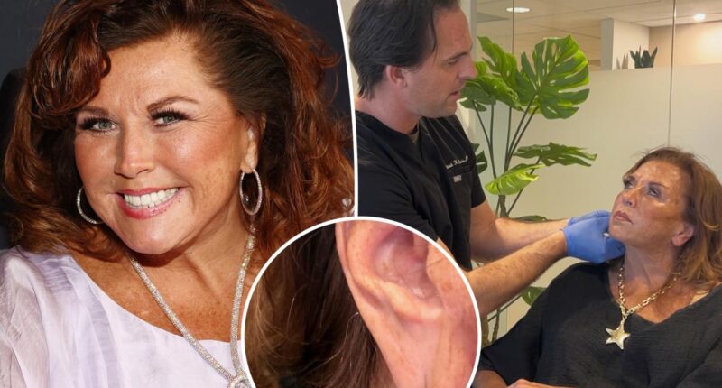 Abby Lee Miller shows off 'amazing' $1K ear rejuvenation surgery results
