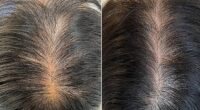 Scalp before and after photos following platelet-rich plasma (PRP) therapy with Lisa Franklin