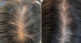 Scalp before and after photos following platelet-rich plasma (PRP) therapy with Lisa Franklin