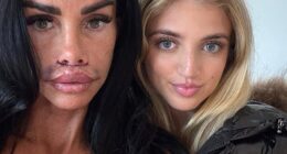 Katie Price has revealed the results of her corrective lip surgery, as she showed her bruised and swollen pout in a new social media post