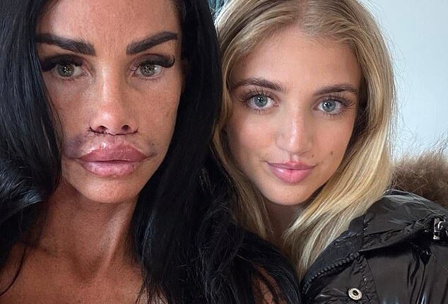 Katie Price has revealed the results of her corrective lip surgery, as she showed her bruised and swollen pout in a new social media post