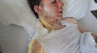 Jacob Smith, 20, was working his shift at McDonald's in Yuba City on May 30 when a coworker allegedly tossed burning hot oil all over him, leaving him with second-degree burns across his face and body