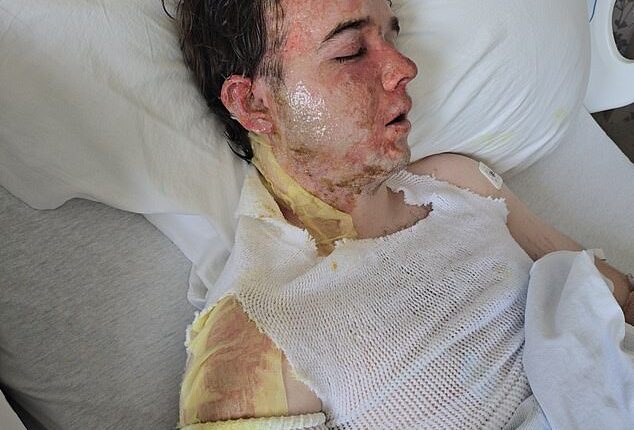Jacob Smith, 20, was working his shift at McDonald's in Yuba City on May 30 when a coworker allegedly tossed burning hot oil all over him, leaving him with second-degree burns across his face and body