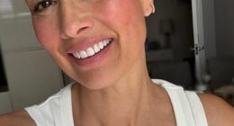 Melanie Sykes has shown off her completely bald head days after revealing she had lost 'two-thirds' of her hair