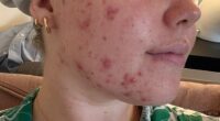 Chloe first got acne when she was 13. By 16, she'd tried every cream and gel and, at 17, her GP put her on the contraceptive pill in the hope it would cure her acne
