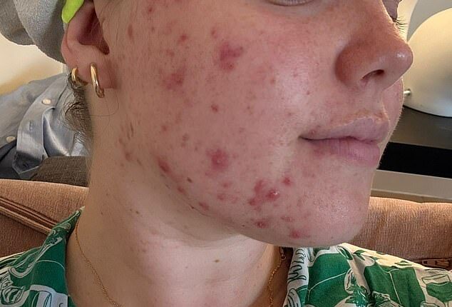 Chloe first got acne when she was 13. By 16, she'd tried every cream and gel and, at 17, her GP put her on the contraceptive pill in the hope it would cure her acne
