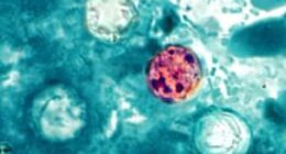 The cyclospora parasite (pictured above) causes cyclosporiasis, an infection that leads to diarrhea, severe cramping, nausea and vomiting and fatigue