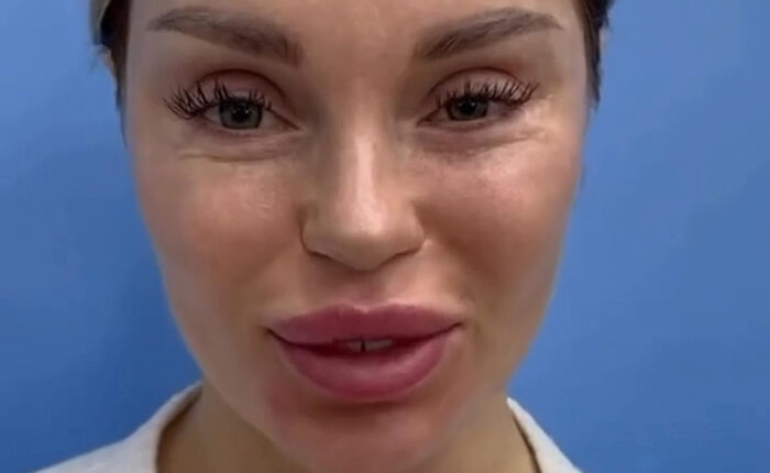 Woman&rsquo;s Post-Plastic Surgery Photos Divide The Internet As She And Her Surgeon Celebrate The Results